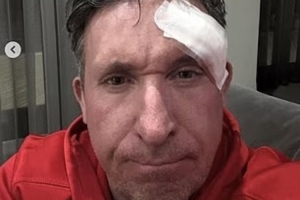 郵報：50歲利物浦名宿羅比·福勒已接受面部腫瘤切除手術